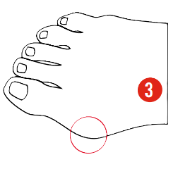 Targeted shell and zone molding to widen the ski boot and relieve big toe bunion pressure for Oshkosh area skiers.