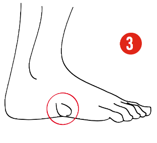 Targeted shell and zone molding to reshape the boot and relieve pressure on the outer edge of the foot for Oshkosh skiers.