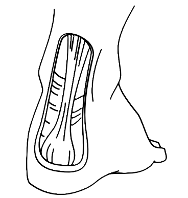 Targeted shell and zone molding to reshape the back of the boot, relieving heel pressure for skiers in Oshkosh, Wisconsin.